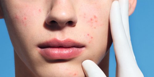 Qué la grasa al acné? ¿Cómo prevenirla?