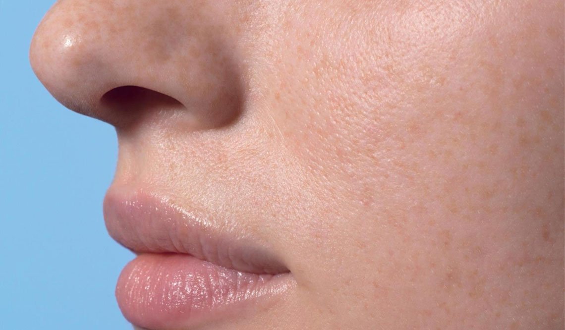 Larocheposay SubCategoryPage Damaged Localised skin damages